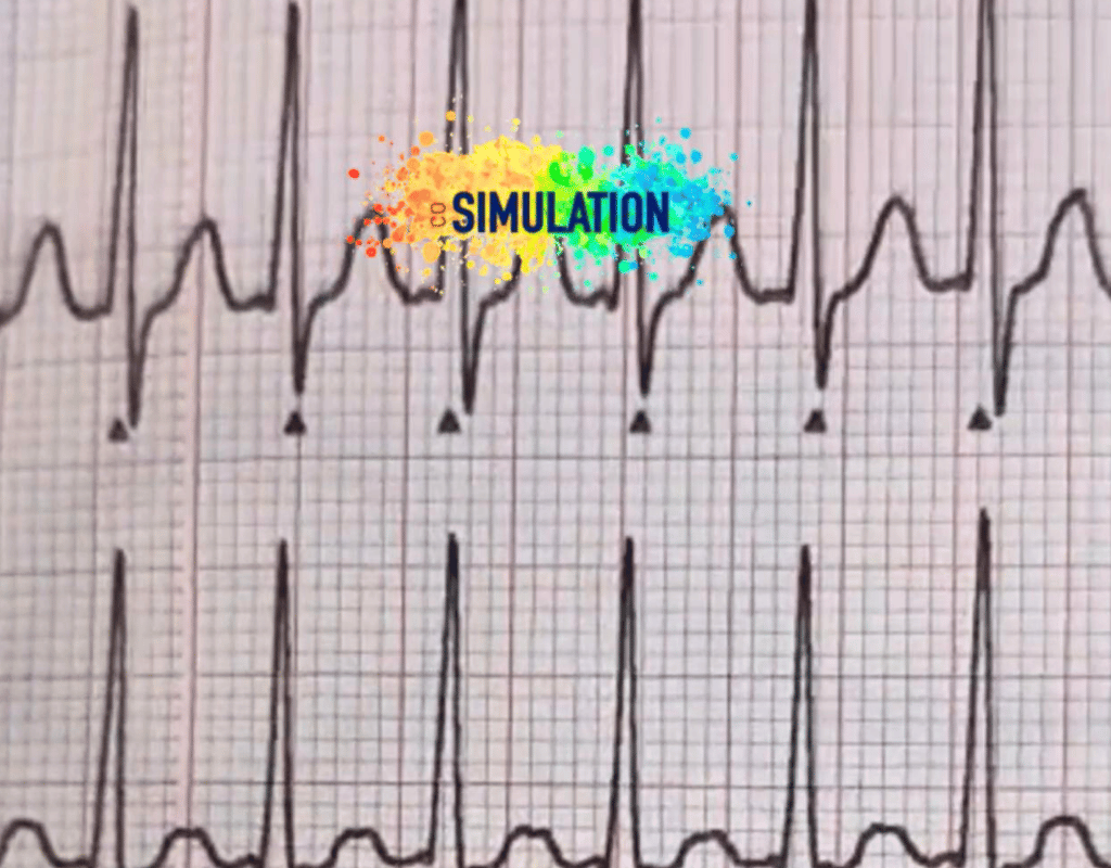 electrocardiografia TES